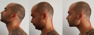 Tre immagini di profilo che mostrano posture diverse del collo con la curvatura del rachide cervicale evidenziata da una linea rossa.