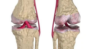 Rappresentazione anatomica del ginocchio con femore, tibia e legamenti evidenziati in rosso per mostrare la stabilità articolare.