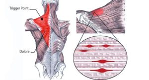 Illustrazione anatomica della schiena con evidenziazione di un trigger point muscolare e relative aree di dolore, con dettaglio dei fasci muscolari e punti di tensione.