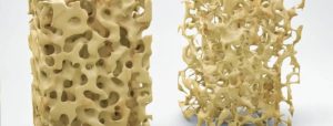 Modelli tridimensionali comparativi di tessuto osseo sano e osteoporotico, evidenziando la densità e la porosità.