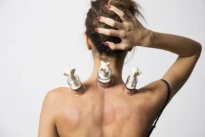 Donna di spalle con coppette per coppettazione applicate sulla schiena, usata per stimolare il flusso sanguigno e alleviare tensioni muscolari.