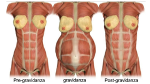 Illustrazione dei cambiamenti nei muscoli addominali femminili durante le fasi di pre-gravidanza, gravidanza e post-gravidanza.