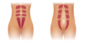  Illustrazione comparativa di muscoli addominali normali e diastasi addominale con muscoli evidenziati in rosso.