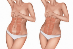 Confronto visivo tra muscolatura addominale femminile prima e dopo un programma di tonificazione.