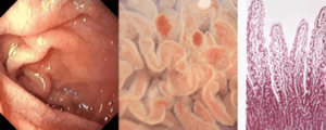 L'immagine mostra tre diverse viste del tessuto intestinale: una endoscopica dell'intestino tenue, una vista ravvicinata dei villi intestinali e una microscopica dei villi colorati.