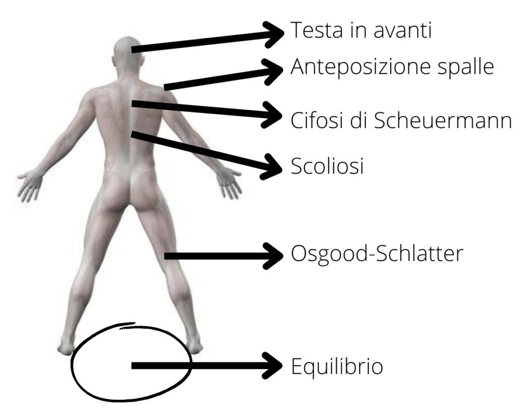 scoliosi e cifosi nell'adolescente