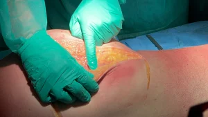 Primo piano di una dissezione anatomica su cadavere che mostra mani guantate mentre espongono il tessuto adiposo sottocutaneo.