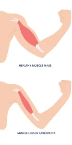 Illustrazione comparativa di un braccio flesso con bicipite sano sopra e bicipite atrofico sotto, evidenziando la perdita muscolare nella sarcopenia.