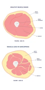 Diagramma comparativo di una coscia giovane con massa muscolare sana sopra e una coscia anziana con perdita muscolare da sarcopenia sotto, mostrando infiltrazione di grasso.
