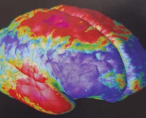 Rappresentazione tridimensionale dell’attività cerebrale tramite neuroimaging funzionale con aree ad alta attivazione evidenziate in rosso e giallo