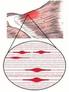 Illustrazione del punto trigger nel muscolo trapezio con area di dolore riferito e ingrandimento della contrazione delle fibre muscolari